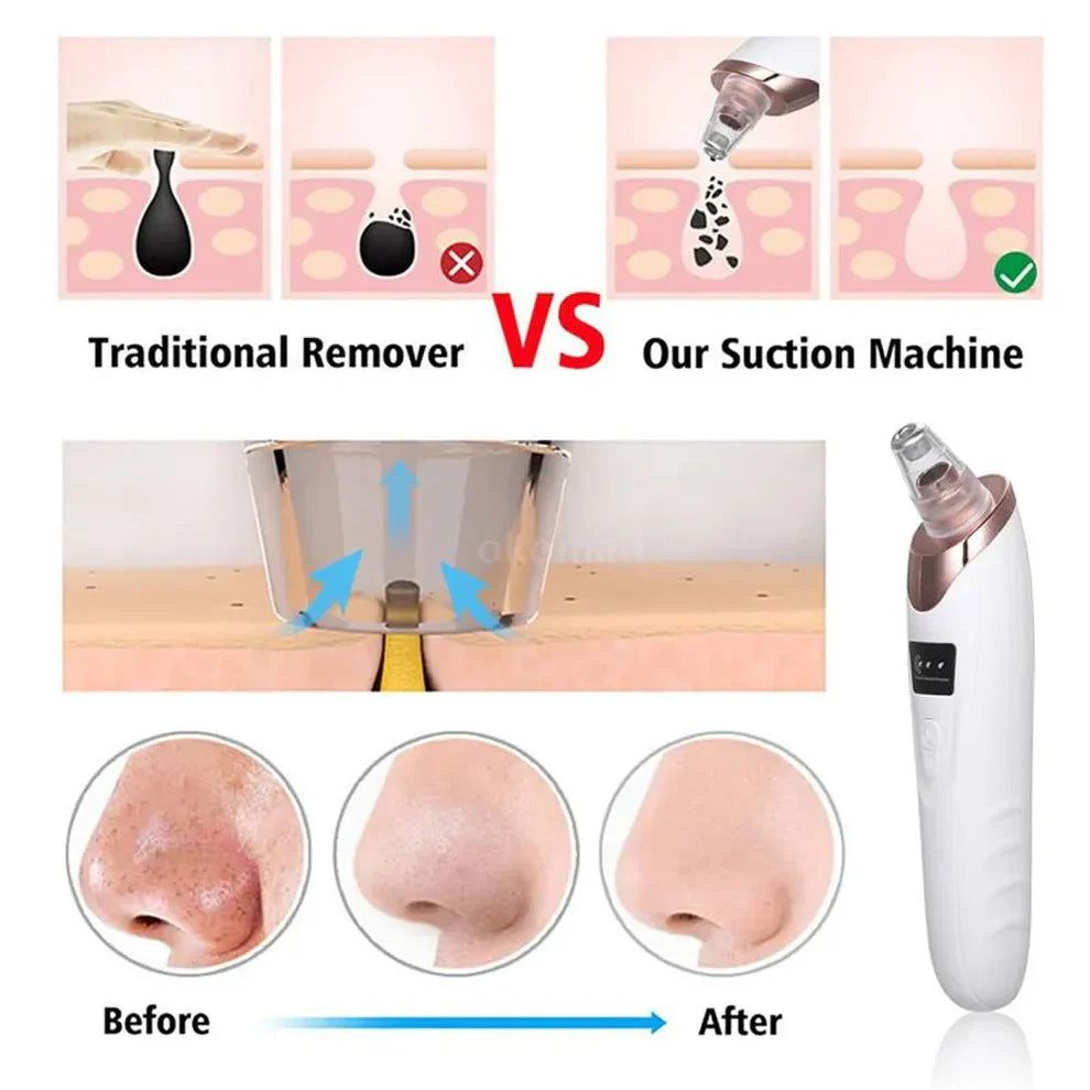Blackhead Removal Machine – Skin Care & Pore Cleaner